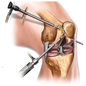 عملية منظار الركبة